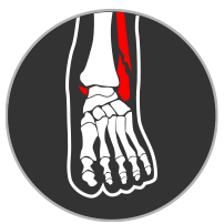 ankle fracture