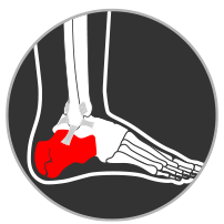 ankle stress fracture