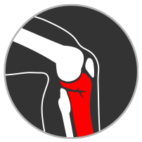 fracture icon